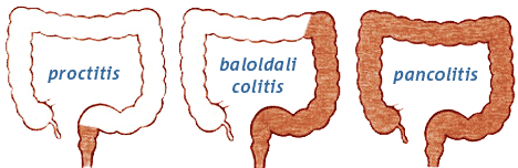 proctitis - baloldali colitis -  pancolitis