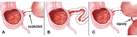 Crohn betegsg